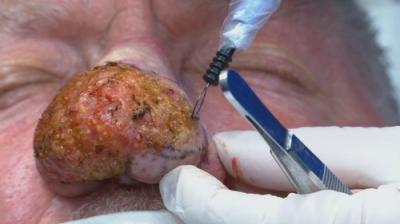 Dr. Pimple Popper: Breaking Out