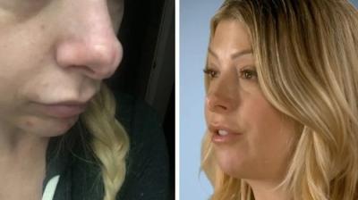 Botched